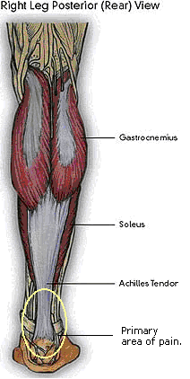 Achilles Tendonitis